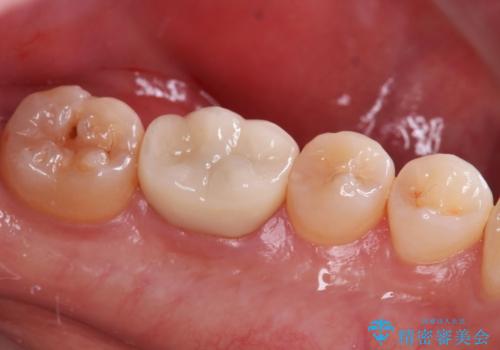 【セラミックインレー】奥歯の詰め物とれたの症例 治療前