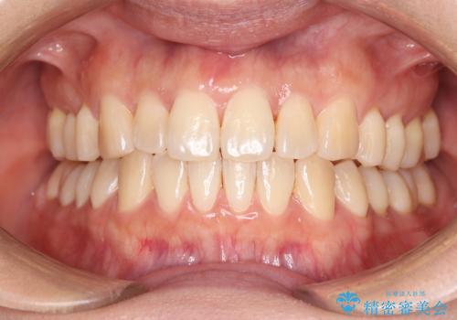 【インビザライン】前歯の捻れ気になるの症例 治療後