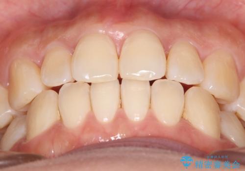 【インビザライン】前歯の捻れ気になるの治療後