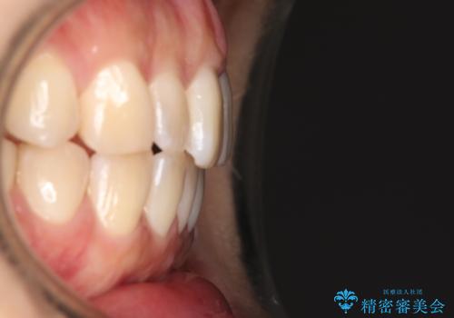 【インビザライン】前歯の捻れ気になるの治療後