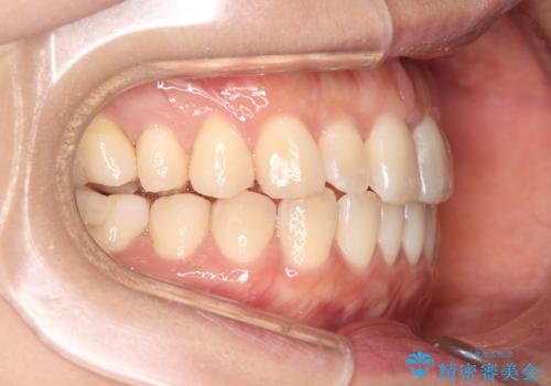 【インビザライン】前歯の捻れ気になるの治療後