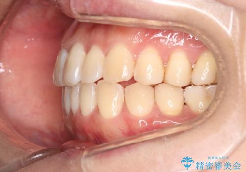【インビザライン】前歯の捻れ気になるの治療後
