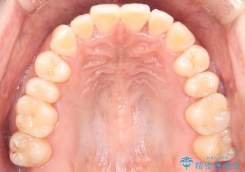 【インビザライン】前歯の捻れ気になるの治療後