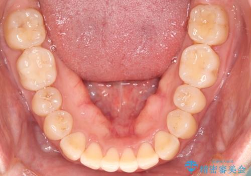 【インビザライン】前歯の捻れ気になるの治療後