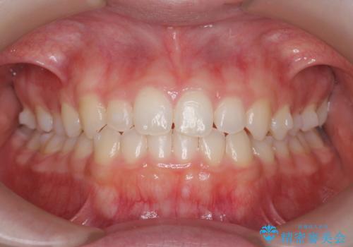 前歯のねじれ、がたつきをしっかり改善 部分ワイヤー+マウスピース矯正の治療中