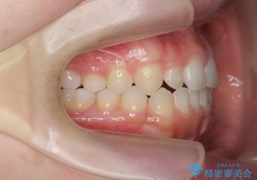 前歯のねじれ、がたつきをしっかり改善　部分ワイヤー+マウスピース矯正の治療中