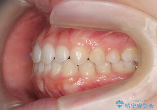 前歯のねじれ、がたつきをしっかり改善　部分ワイヤー+マウスピース矯正の治療中