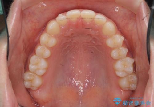前歯のねじれ、がたつきをしっかり改善 部分ワイヤー+マウスピース矯正の治療中