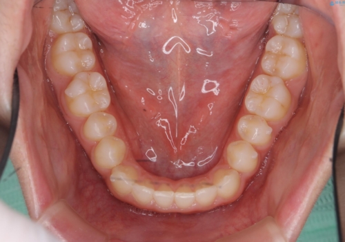 前歯のねじれ、がたつきをしっかり改善　部分ワイヤー+マウスピース矯正の治療中