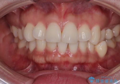 デコボコと正中のずれを改善した矯正治療の治療前