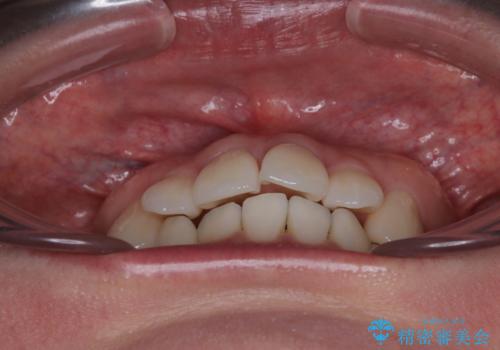 デコボコと正中のずれを改善した矯正治療の治療前