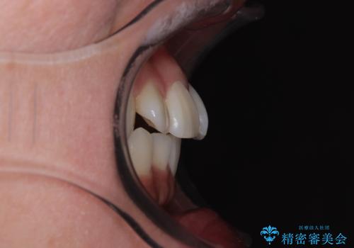 デコボコと正中のずれを改善した矯正治療の治療前