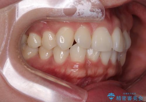 デコボコと正中のずれを改善した矯正治療の治療前