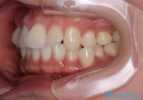 デコボコと正中のずれを改善した矯正治療の治療前