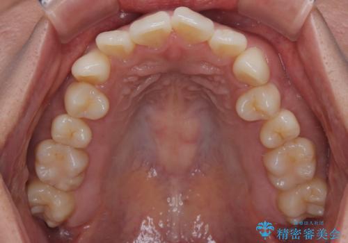 デコボコと正中のずれを改善した矯正治療の治療前