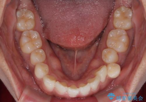 デコボコと正中のずれを改善した矯正治療の治療前