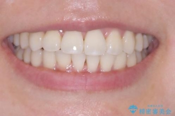 デコボコと正中のずれを改善した矯正治療の治療後(顔貌)