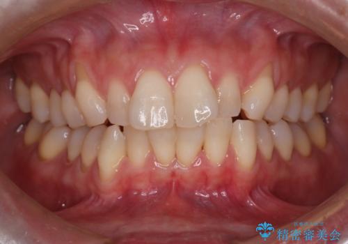 【インビザライン】上の前歯出ているのが気になるの治療前