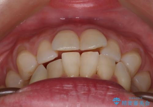 【インビザライン】上の前歯出ているのが気になるの治療前
