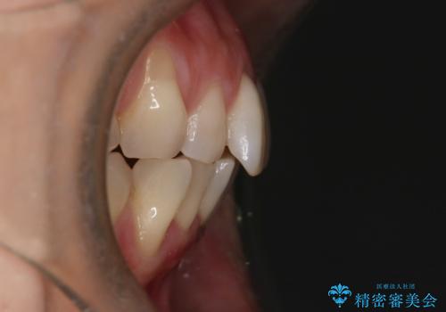 【インビザライン】上の前歯出ているのが気になるの治療前