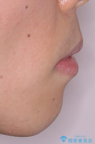 口が閉じにくい原因を根本から改善|上下顎4本抜歯による矯正治療症例の治療後(顔貌)