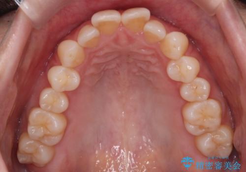【インビザライン】上の前歯出ているのが気になるの治療前
