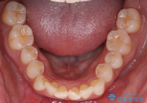 【インビザライン】上の前歯出ているのが気になるの治療前