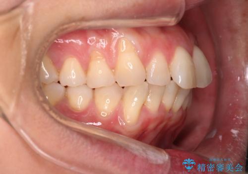 【インビザライン】上の前歯出ているのが気になるの治療前