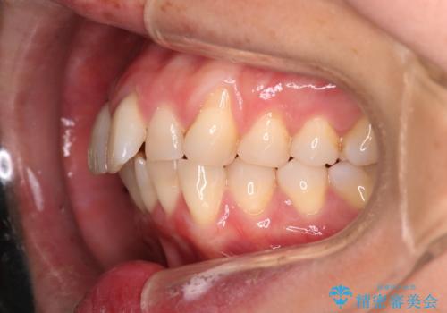 【インビザライン】上の前歯出ているのが気になるの治療前