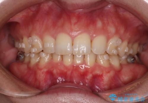 【インビザラインとワイヤー矯正】がたつきと噛み合わせを改善!の治療中