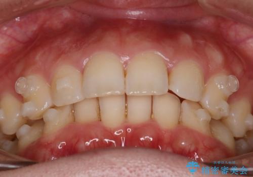 【インビザラインとワイヤー矯正】がたつきと噛み合わせを改善!の治療中