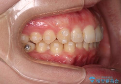 【インビザラインとワイヤー矯正】がたつきと噛み合わせを改善!の治療中