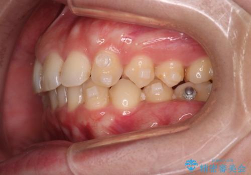 【インビザラインとワイヤー矯正】がたつきと噛み合わせを改善!の治療中