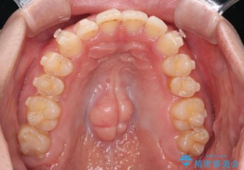 【インビザラインとワイヤー矯正】がたつきと噛み合わせを改善!の治療中