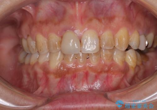 むし歯治療とインビザライン矯正治療 総合歯科治療で整った口腔内にの治療中