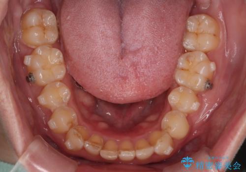 【インビザラインとワイヤー矯正】がたつきと噛み合わせを改善!の治療中