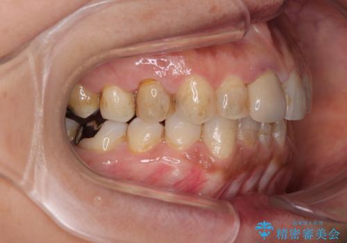 むし歯治療とインビザライン矯正治療 総合歯科治療で整った口腔内にの治療中