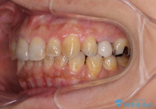 むし歯治療とインビザライン矯正治療 総合歯科治療で整った口腔内にの治療中