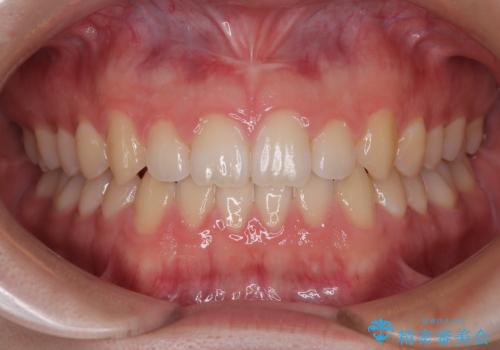 すきっ歯は放置NG?インビザラインで目立たず改善の症例 治療後