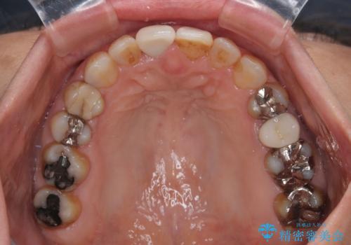 むし歯治療とインビザライン矯正治療 総合歯科治療で整った口腔内にの治療中