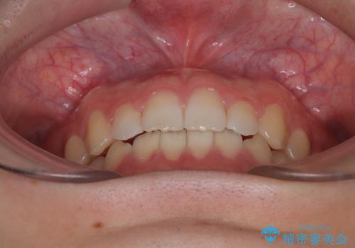 すきっ歯は放置NG?インビザラインで目立たず改善の治療後