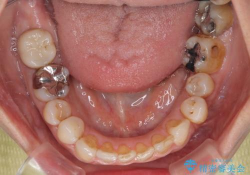 むし歯治療とインビザライン矯正治療 総合歯科治療で整った口腔内にの治療中