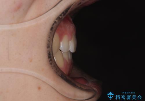 すきっ歯は放置NG?インビザラインで目立たず改善の治療後