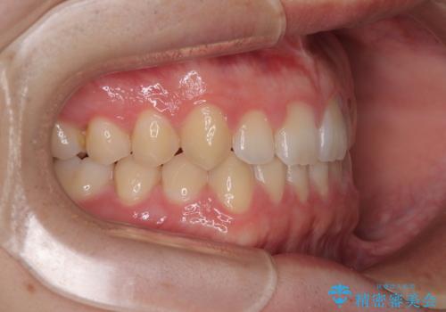 すきっ歯は放置NG?インビザラインで目立たず改善の治療後