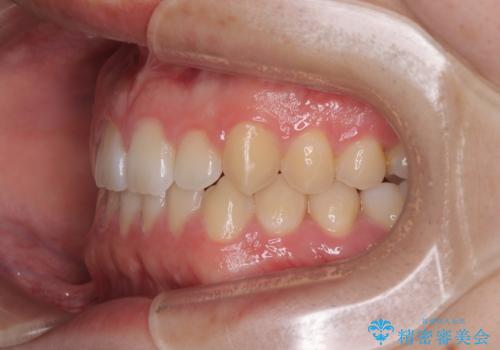 すきっ歯は放置NG?インビザラインで目立たず改善の治療後
