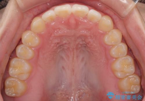 すきっ歯は放置NG?インビザラインで目立たず改善の治療後