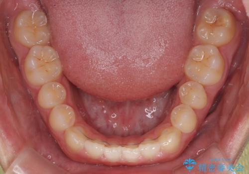 すきっ歯は放置NG?インビザラインで目立たず改善の治療後