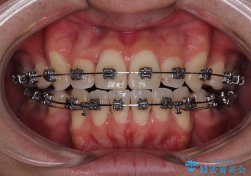 口が閉じにくい原因を根本から改善|上下顎4本抜歯による矯正治療症例の治療中