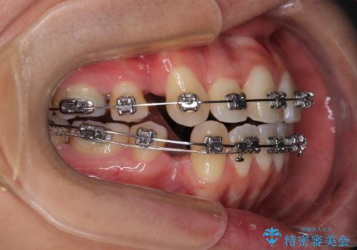 口が閉じにくい原因を根本から改善|上下顎4本抜歯による矯正治療症例の治療中