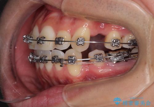 口が閉じにくい原因を根本から改善|上下顎4本抜歯による矯正治療症例の治療中